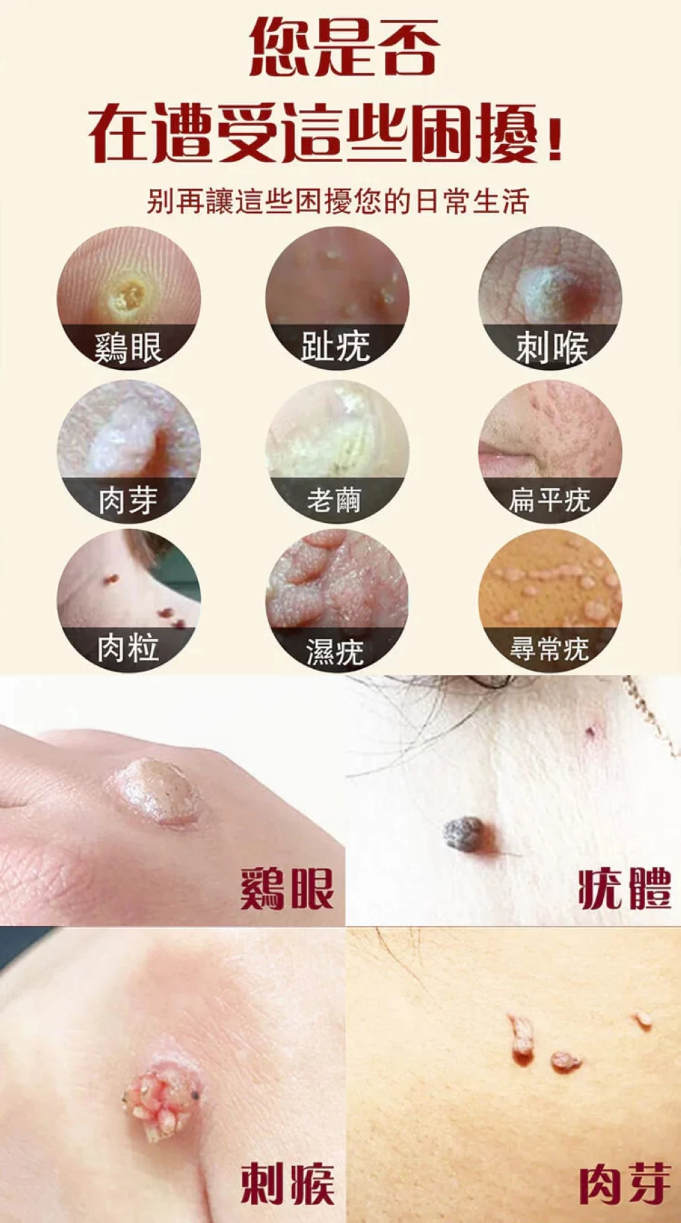 点痣祛疣皮肤净瑕护理