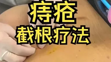 痔疮反复、坐立难安？——了解“截根疗法”的一次勇敢尝试